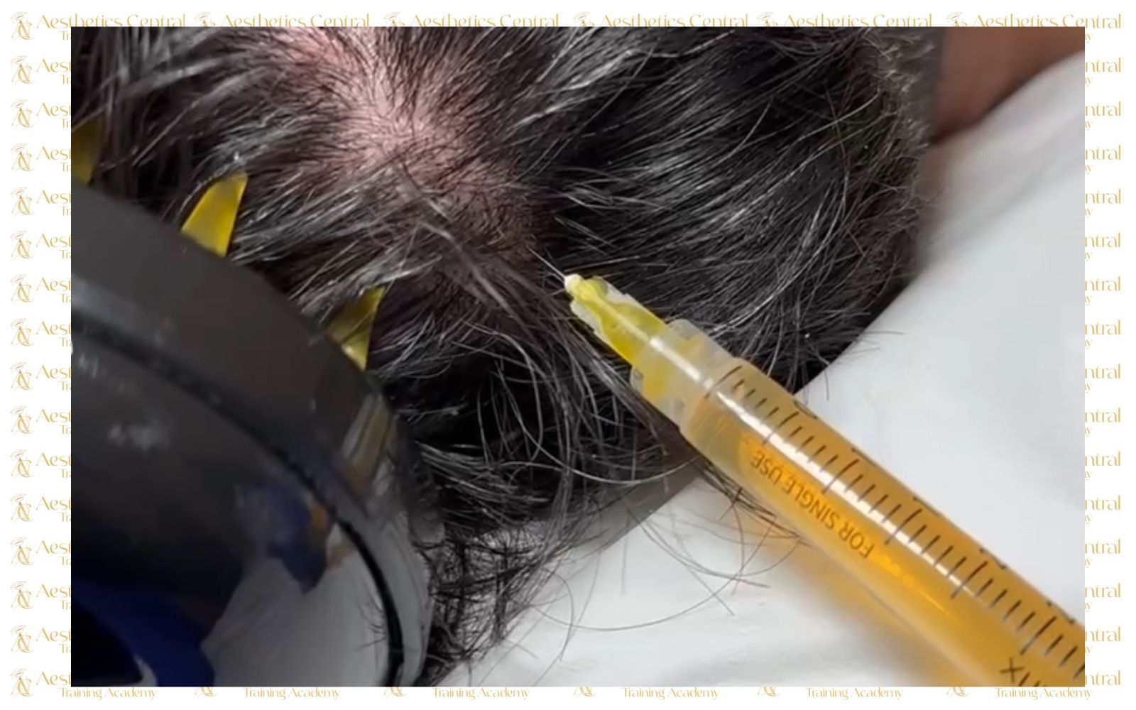 Platelet Rich Plasma PRP Therapy