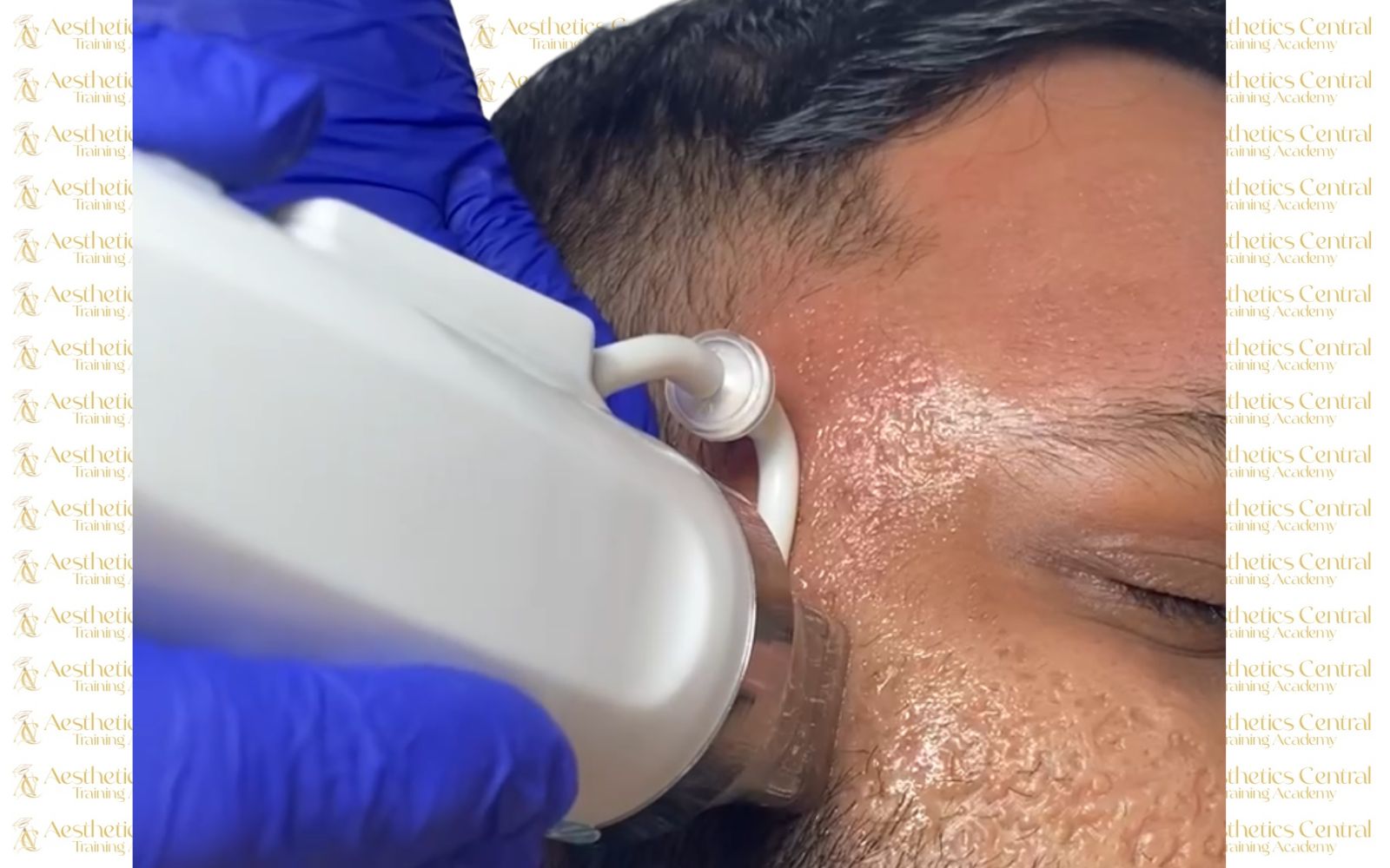 RF Microneedling