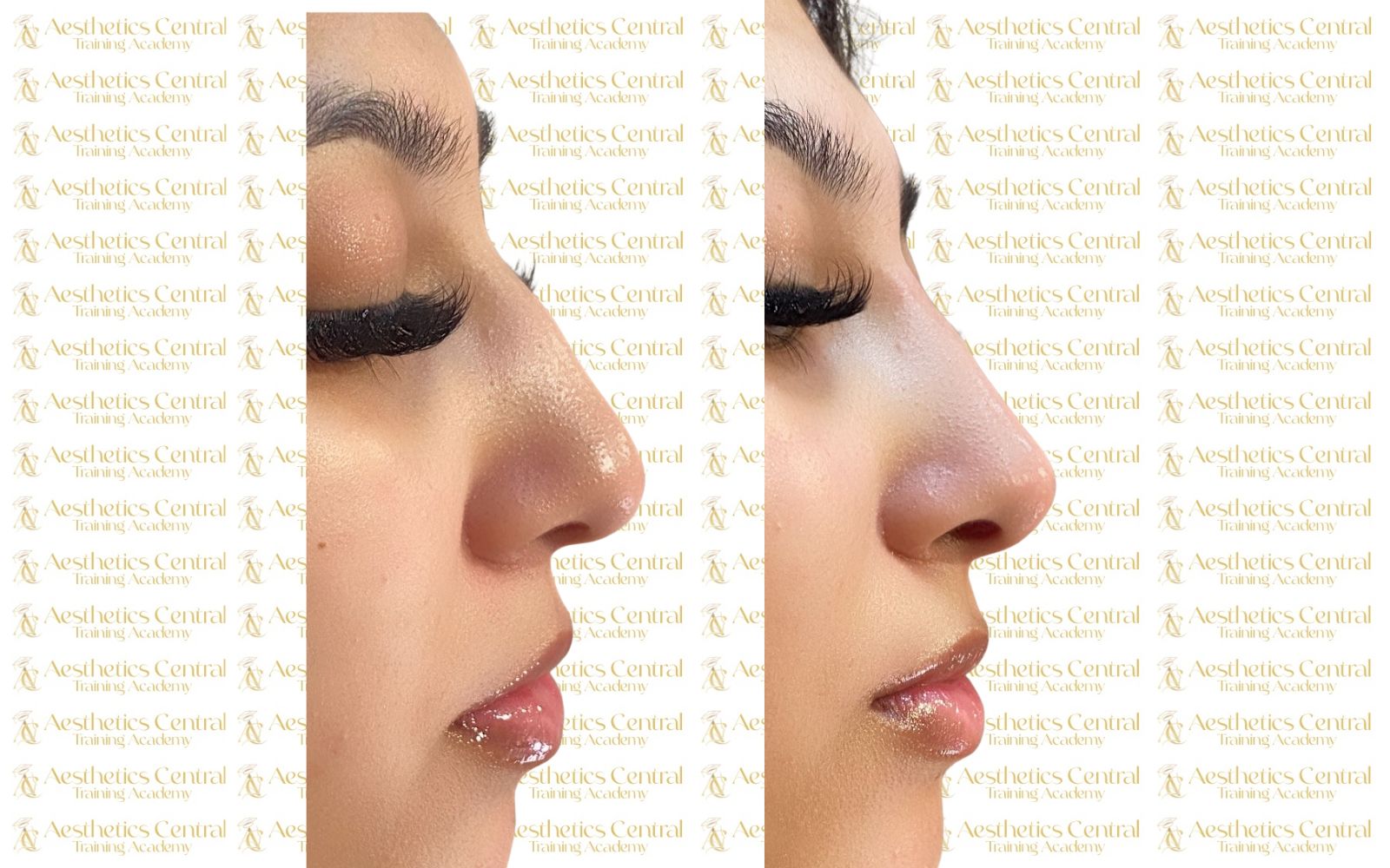 Advanced Dermal Fillers