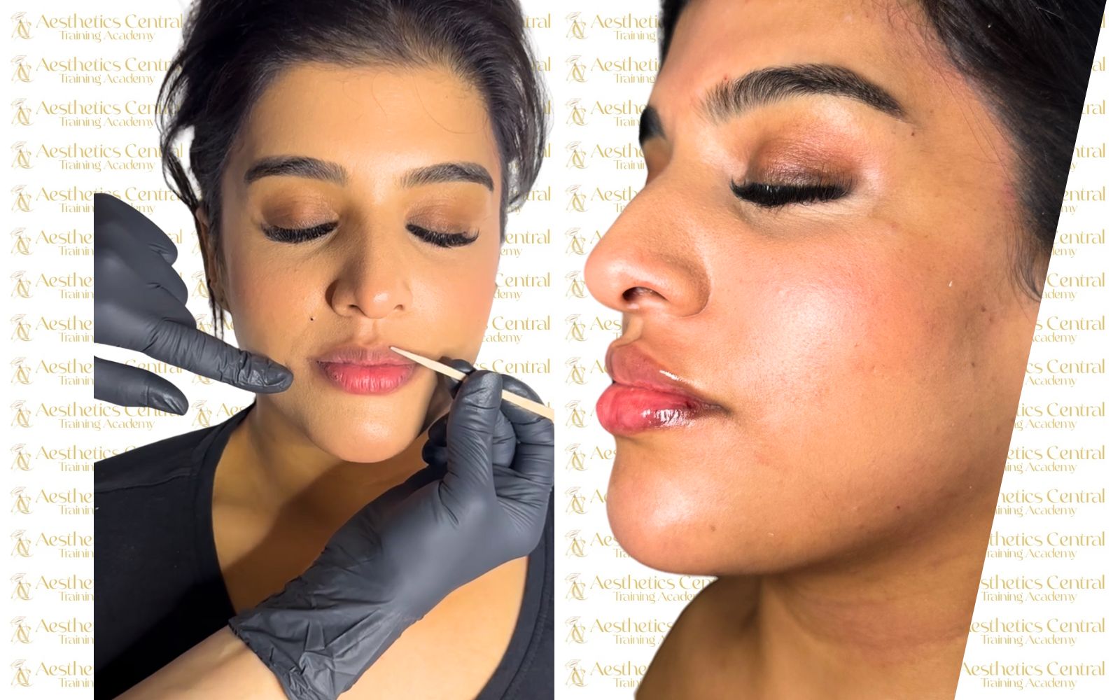 Foundation Dermal Filler