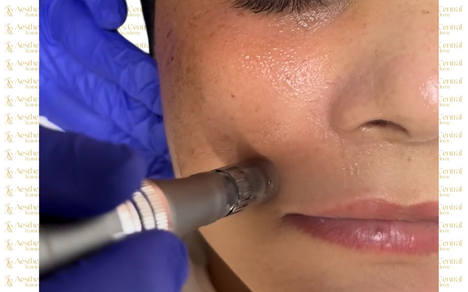 Microneedling