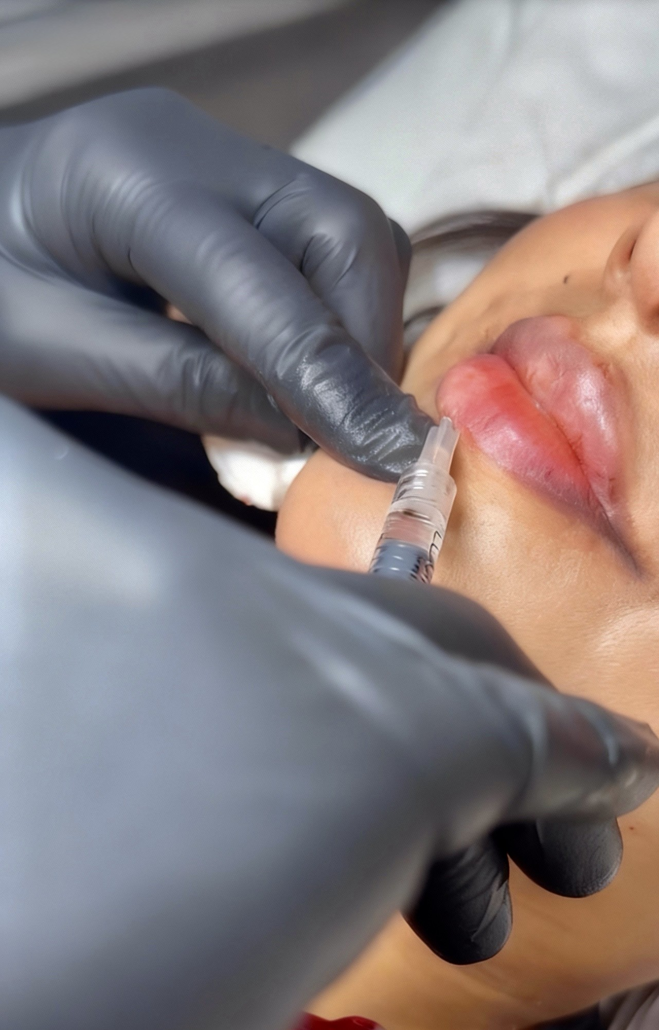 Foundation Dermal Filler