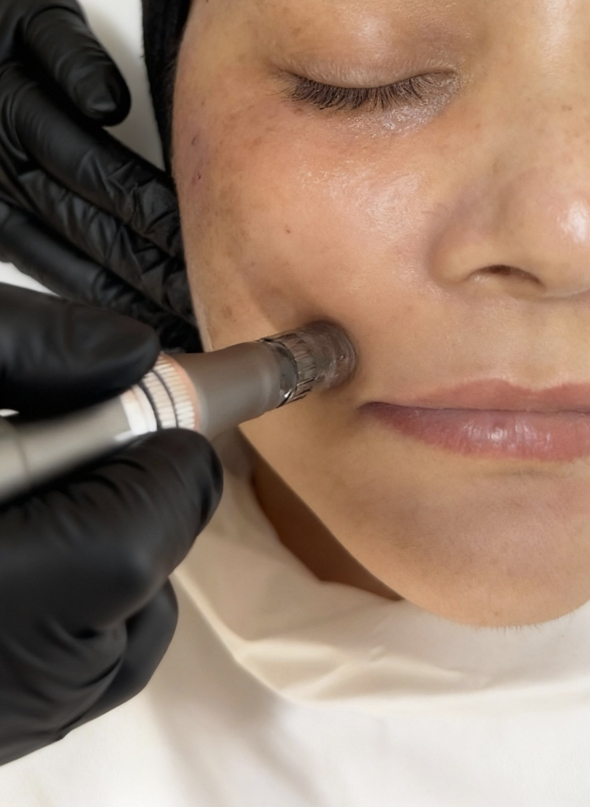 Microneedling